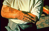 Hands damaged by kerosene