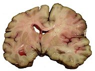 MCA-Stroke-Brain-Human-2.JPG