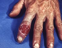 Extragenital syphilitic chancre of the left index finger PHIL 4147 lores