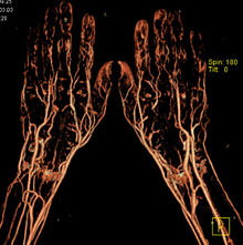 CT-Angiografie-Haende